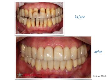 Полная реабилитация